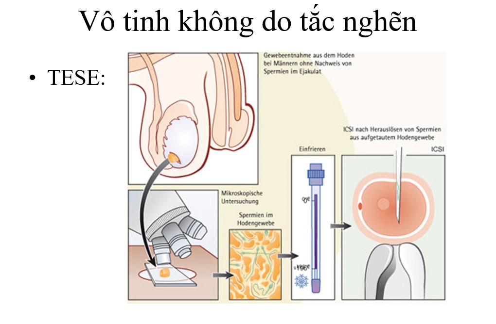 kỸ THUẬT TESE ĐỂ TÌM TINH TRÙNG