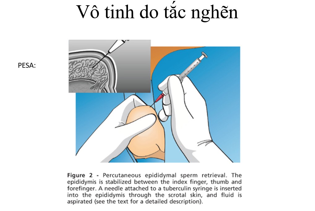 Thủ thuật PESA để tìm tinh trùng